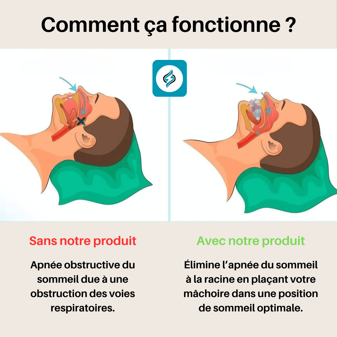 Gouttière de Nuit Anti-Ronflement